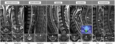 Neuroimaging features in inflammatory myelopathies: A review